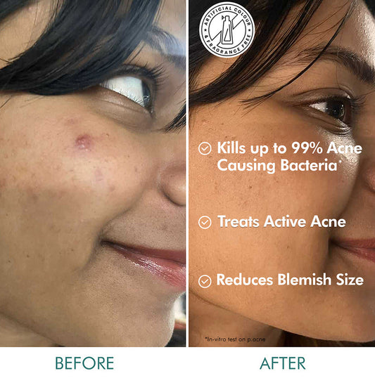 1% Salicylic Acid 1% Succinic Acid Acne Arrest Spot Corrector with Matcha Tea-15 ml
